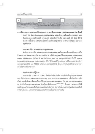 àÇªÈÒÊµÃ·¹ÂØ¤ 2553
          Ñ                                                                                         39




ÀÒ¾·Õè 2 áÊ´§ÀÒ¾·Ò§¾ÂÒ¸ÔÇÔ·ÂÒ ¢Í§¡ÒÃà¾ÒÐàÅÕéÂ§ Corneal Limbal stem cell : (A) ÂŒÍÁÊÕ
        H&E, (B) ÂŒ Í Á immunohistochemistry áÊ´§¶Ö § áÍ¹µÔ à ¨¹·Õè á Ê´§ÍÍ¡ áÅÐ
        äÁ‹áÊ´§ÍÍ¡º¹¼ÔÇà«ÅÅ ÂŒÍÁ p63 áÊ´§¶Ö§¡ÒÃà»š¹ stem cell, (C) ÂŒÍÁ CK12
        µÔ ´ à«ÅÅ ªÑé ¹ º¹ áÊ´§¶Ö § à«ÅÅ ·Õè á º‹ § µÑ Ç à¨ÃÔ ­ àµÔ º âµä´Œ à »š ¹ à«ÅÅ ¢ Í§ corneal
        epithelium

        ¡ÒÃà¾ÒÐàÅÕéÂ§ oral mucosal epithelium
         ´íÒà¹Ô¹¡ÒÃà¾ÒÐàÅÕÂ§ human oral mucosal epithelial cell ã¹ÍÒËÒÃàÅÕÂ§à«ÅÅã¹ÊÀÒÇÐ·ÕäÁ‹
                          é                                               é                è
ÁÕ serum áÅÐ feeder cell à»š¹àÇÅÒ 2-3 ÊÑ»´ÒË áÅŒÇÈÖ¡ÉÒ¤Ø³ÊÁºÑµ¢Í§ epithelial differentiation
                                                                     Ô
marker (cytokeration K (CK) 12 and CK3) áÅÐ stem cell marker (ABCG2) ´ŒÇÂÇÔ¸Õ reverse
transcription-polymerase chain reaction (RT-PCR) à«ÅÅ·à¾ÒÐàÅÕÂ§ÀÒÂãµŒÊÀÒÇÐ´Ñ§¡Å‹ÒÇÁÕ¡ÒÃ
                                                           Õè      é
áÊ´§ÍÍ¡¢Í§ CK3 áÅÐ ABCG2 áµ‹äÁ‹áÊ´§ÍÍ¡¢Í§ CK12 «Ö§áÊ´§Ç‹Òà»š¹à«ÅÅ·¤ÅŒÒÂ¡ÃÐ¨¡µÒ
                                                              è                Õè
áµ‹äÁ‹ãª‹à«ÅÅ¢Í§¡ÃÐ¨¡µÒ

        ¡ÒÃ·íÒ¼‹ÒµÑ´á¡‹¼ÙŒ»†ÇÂ
           ¡ÒÃ·íÒ¼‹ÒµÑ´ CCET áÅÐ COMET ÁÕËÅÑ¡¡ÒÃà´ÕÂÇ¡Ñ¹¤×Í ÅÍ¡¾Ñ§¼×´·Õ¤ÅØÁ ocular surface
                                                                              è
ÍÍ¡ ·Ñ§ã¹Ê‹Ç¹¢Í§ cornea áÅÐ conjunctiva ÇÒ§¹éÒÂÒ 0.02% mitomycin C à¾×Í»‡Í§¡Ñ¹¡ÒÃ¡ÅÑº
         é                                       í                                è
à»š¹«éÒ¢Í§¾Ñ§¼×´ ¨Ò¡¹Ñ¹ÇÒ§àÂ×ÍÃ¡·ÕÁà«ÅÅ¢Í§ corneal epithelium ËÃ×Í oral mucosal epithelium
       í                 é    è      è Õ
ÍÂÙ‹ àÂçºµÔ´¡Ñº sclera áÅÐ cornea Ê‹Ç¹·ÕÅÍ¡¾Ñ§¼×´ÍÍ¡áÅŒÇ(6-8, 10, 19,20) «Ö§¨Ð¾ºÇ‹ÒÊÒÁÒÃ¶·íÒãËŒÁÕ
                                         è                                 è
à«ÅÅ¤ÅØÁá¼Åä´Œ·§ËÁ´ËÃ×Íà¡×Íº·Ñ§ËÁ´µÑ§áµ‹ËÅÑ§¼‹ÒµÑ´ ã¹ÃÒÂ·Õà¹×Í¡ÃÐ¨¡µÒ¢Ø¹ ËÅÑ§¨Ò¡á¼ÅµÔ´´Õ
                    Ñé             é       é                    è é             ‹
¡ÒÃÍÑ¡àÊºÅ´Å§ áµ‹¡ÃÐ¨¡µÒÂÑ§¢Ø¹ÍÂÙ‹ ¨Ð·íÒ¡ÒÃà»ÅÕÂ¹¡ÃÐ¨¡µÒµ‹Íä»
                                 ‹                 è
 