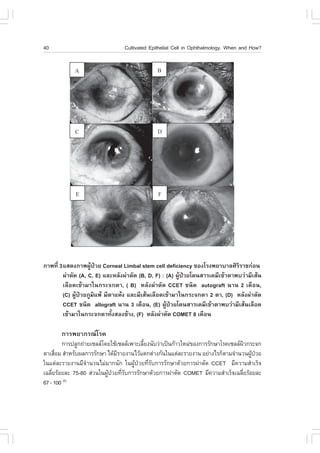 40                               Cultivated Epithelial Cell in Ophthalmology, When and How?




ÀÒ¾·Õè 3áÊ´§ÀÒ¾¼ÙŒ»†ÇÂ Corneal Limbal stem cell deficiency ¢Í§âÃ§¾ÂÒºÒÅÈÔÃÔÃÒª¡‹Í¹
        ¼‹ÒµÑ´ (A, C, E) áÅÐËÅÑ§¼‹ÒµÑ´ (B, D, .) : (A) ¼ÙŒ»†ÇÂâ´¹ÊÒÃà¤ÁÕà¢ŒÒµÒ¾ºÇ‹ÒÁÕàÊŒ¹
        àÅ×Í´à¢ŒÒÁÒã¹¡ÃÐ¨¡µÒ, ( B) ËÅÑ§¼‹ÒµÑ´ CCET ª¹Ô´ autograft ¹Ò¹ 2 à´×Í¹,
        (C) ¼ÙŒ»†ÇÂÀÙÁÔá¾Œ ÁÕµÒáËŒ§ áÅÐÁÕàÊŒ¹àÅ×Í´à¢ŒÒÁÒã¹¡ÃÐ¨¡µÒ 2 µÒ, (D) ËÅÑ§¼‹ÒµÑ´
        CCET ª¹Ô´ allograft ¹Ò¹ 3 à´×Í¹, (E) ¼ÙŒ»†ÇÂâ´¹ÊÒÃà¤ÁÕà¢ŒÒµÒ¾ºÇ‹ÒÁÕàÊŒ¹àÅ×Í´
        à¢ŒÒÁÒã¹¡ÃÐ¨¡µÒ·Ñé§ÊÍ§¢ŒÒ§, (.) ËÅÑ§¼‹ÒµÑ´ COMET 8 à´×Í¹

       ¡ÒÃ¾ÂÒ¡Ã³âÃ¤
         ¡ÒÃ»ÅÙ¡¶‹ÒÂà«ÅÅâ´ÂãªŒà«ÅÅà¾ÒÐàÅÕÂ§¹ÑºÇ‹Òà»š¹¡ŒÒÇãËÁ‹¢Í§¡ÒÃÃÑ¡ÉÒâÃ¤à«ÅÅ¼Ç¡ÃÐ¨¡
                                           é                                         Ô
µÒàÊ×ÍÁ ÊíÒËÃÑº¼Å¡ÒÃÃÑ¡ÉÒ ä´ŒÁÃÒÂ§Ò¹äÇŒáµ¡µ‹Ò§¡Ñ¹ã¹áµ‹ÅÐÃÒÂ§Ò¹ ÍÂ‹Ò§äÃ¡çµÒÁ¨íÒ¹Ç¹¼Ù»ÇÂ
      è                         Õ                                                      Œ †
ã¹áµ‹ÅÐÃÒÂ§Ò¹ÁÕ¨íÒ¹Ç¹äÁ‹ÁÒ¡¹Ñ¡ ã¹¼ÙŒ»†ÇÂ·ÕèÃÑº¡ÒÃÃÑ¡ÉÒ´ŒÇÂ¡ÒÃ¼‹ÒµÑ´ CCET ÁÕ¤ÇÒÁÊíÒàÃç¨
à©ÅÕÂÃŒÍÂÅÐ 75-80 Ê‹Ç¹ã¹¼Ù»ÇÂ·ÕÃº¡ÒÃÃÑ¡ÉÒ´ŒÇÂ¡ÒÃ¼‹ÒµÑ´ COMET ÁÕ¤ÇÒÁÊíÒàÃç¨à©ÅÕÂÃŒÍÂÅÐ
    è                      Œ † èÑ                                                  è
67 - 100 (5)
 