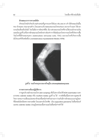 62                                                                   âÃ¤àª×ÍÃÒ·Õ¼ÇË¹Ñ§ªÑ¹ÅÖ¡
                                                                           é    è Ô     é

       ÅÑ¡É³ÐÍÒ¡ÒÃ·Ò§¤ÅÔ¹Ô¡
       à¡Ô´ÃÍÂâÃ¤ÁÑ¡à¡Ô´ºÃÔàÇ³µíÒáË¹‹§·Õ¶¡¡ÃÐá·¡ä´ŒºÍÂ àª‹¹ á¢¹ ¢Ò à·ŒÒ ÁÕÅ¡É³Ðà»š¹»„¹
                                         è Ù             ‹                  Ñ           œ
Ë¹Ò ¼ÔÇ¢ÃØ¢ÃÐ ¤‹ÍÂæÅÒÁªŒÒæ â´Âà©¾ÒÐºÃÔàÇ³¢Íº¢Í§ÃÍÂâÃ¤¨Ð¤‹ÍÂæ ¢ÂÒÂ¡ÇŒÒ§ÍÍ¡ ãªŒàÇÅÒ
¹Ò¹à»š¹à´×Í¹¶Ö§à»š¹»‚ â´ÂäÁ‹ÁÍÒ¡ÒÃ¼Ô´»¡µÔÍ¹ ÁÕºÒ§Ê‹Ç¹¢Í§ÃÍÂâÃ¤·ÕËÒÂä´ŒàÍ§áÅŒÇ¡ÅÒÂà»š¹
                               Õ             ×è                     è
á¼Åà»š¹ (ÃÙ»·Õè 2) «Ö§¨Ò¡ÅÑ¡É³ÐÃÍÂâÃ¤´Ñ§¡Å‹ÒÇµŒÍ§·íÒ¡ÒÃÇÔ¹¨©ÑÂáÂ¡âÃ¤¨Ò¡ÃÍÂâÃ¤·Õà¡Ô´¨Ò¡àª×Í
                     è                                     Ô                   è          é
ÇÑ³âÃ¤·ÕèÁÕÅÑ¡É³Ð¢ÃØ¢ÃÐ (tuberculosis verrucosa cutis; TVC) áÅÐÃÍÂâÃ¤·Õèà¡Ô´¨Ò¡àª×éÍ
ÁÑÂâ¤áº¤·ÕàÃÕÂª¹Ô´Í×¹æ (nontuberculous mycobacterial infection; NTM)
                       è




               ÃÙ»·Õè 2 ÃÍÂâÃ¤¢ÃØ¢ÃÐ¢¹Ò´ãË­‹ã¹ chromyblastomycosis

       ¡ÒÃµÃÇ¨·Ò§ËŒÍ§»¯Ôºµ¡ÒÃ
                         Ñ Ô
        ¡ÒÃ¢Ù´ºÃÔàÇ³¼ÔÇ¢Í§ÃÍÂâÃ¤ (skin scraping) à¾×Íä»µÃÇ¨â´ÂÇÔ¸Õ KOH examination ¨ÐÊÒ
                                                    è
ÁÒÃ¶¾º sclerotic bodies ËÃ×Í muriform bodies (ÃÙ»·Õè 3) ä´Œ ¡ÒÃµÑ´ªÔ¹à¹×ÍµÃÇ¨·Ò§¨ØÅ¾ÂÒ¸Ô
                                                                    é é
ÇÔ·ÂÒ ¨Ð¾º¡ÒÃà»ÅÕÂ¹á»Å§Ë¹ÒµÑÇ¢Í§ªÑ¹Ë¹Ñ§¡íÒ¾ÃŒÒÍÂ‹Ò§ÁÒ¡ Ã‹ÇÁ¡ÑºÁÕ¡ÒÃÍÑ¡àÊºáººá¡Ã¹ÙâÅÁÒ
                   è                é
·ÕÁà«ÅÅàÁç´àÅ×Í´¢ÒÇËÅÒÂª¹Ô´ â´Âà©¾ÒÐ¹ÔÇâµÃ¿Å à»š¹ suppurative granuloma ã¹ªÑ¹Ë¹Ñ§á·Œ
  è Õ                                                                           é
áÅÐ¾º sclerotic bodies »¹ÍÂÙã¹ËÂ‹ÍÁà¹×ÍµÒÂáÅÐã¹ªÑ¹Ë¹Ñ§¡íÒ¾ÃŒÒä´Œ
                            ‹         é               é
 