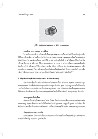 àÇªÈÒÊµÃ·¹ÂØ¤ 2553
          Ñ                                                                                 63




                      ÃÙ»·Õè 3 Sclerotic bodies ¨Ò¡ KOH examination

       ¡ÒÃÃÑ¡ÉÒáÅÐ¡ÒÃ¾ÂÒ¡Ã³âÃ¤
        ã¹ÃÍÂâÃ¤¢¹Ò´àÅç¡¡ÒÃÃÑ¡ÉÒËÅÑ¡¤×Í surgical excision áµ‹ã¹ÃÍÂâÃ¤·ÕÁ¢¹Ò´ãË­‹ÂÒËÅÑ¡
                                                                          è Õ
·ÕãªŒã¹¡ÒÃÃÑ¡ÉÒ ¤×Í ÂÒµŒÒ¹àª×ÍÃÒª¹Ô´ÃÑº»ÃÐ·Ò¹àª‹¹ itraconazole 200-400 Á¡./ÇÑ¹ ËÃ×Í terbinafine
  è                          é
250-500 Á¡./ÇÑ¹ ¨¹¡Ç‹ÒÃÍÂâÃ¤¨ÐËÒÂ«Ö§ãªŒàÇÅÒËÅÒÂà´×Í¹¶Ö§à»š¹»‚ ÊíÒËÃÑºã¹ÃÒÂ·ÕÁÃÍÂâÃ¤à»š¹
                                       è                                        è Õ
ºÃÔàÇ³¡ÇŒÒ§ÁÒ¡ ÍÒ¨¾Ô¨ÒÃ³ÒãËŒÂÒ amphotericin B (¢¹Ò´ 1 Á¡./¡¡./ÇÑ¹) ·Ò§ËÅÍ´àÅ×Í´´íÒ
Ã‹ÇÁ¡Ñº¡ÒÃãªŒ¡ÒÃÃÑ¡ÉÒâ´ÂÇÔ¸Í¹ àª‹¹ ¡ÒÃ¼‹ÒµÑ´ ËÃ×Í ¡ÒÃãªŒ¤ÇÒÁÃŒÍ¹ (local heat therapy) ËÃ×Í
                               Õ ×è
¤ÇÒÁàÂç¹ (cryotherapy) ã¹¡ÒÃÃÑ¡ÉÒÃÍÂâÃ¤ä´Œ áµ‹¤ÇÃàÃÔÁËÅÑ§¨Ò¡ãËŒÂÒÃÑº»ÃÐ·Ò¹ä»áÅŒÇÃÐÂÐË¹Ö§
                                                      è                                       è
à¹×Í§¨Ò¡ÁÕÃÒÂ§Ò¹¢Í§¡ÒÃ¡ÃÐ¨ÒÂ¢Í§àª×Íä»ÊÙºÃÔàÇ³¢ŒÒ§à¤ÕÂ§ËÅÑ§¡ÒÃ¼‹ÒµÑ´ä´Œ
    è                                    é ‹                              (2,4)



3. Mycetoma (Maduromycosis, Madura foot)
       à»š¹¡ÒÃµÔ´àª×éÍàÃ×éÍÃÑ§·Õè¼ÔÇË¹Ñ§à©¾ÒÐ·Õè à¡Ô´¨Ò¡àª×éÍÃÒ ËÃ×Í¨Ò¡ higher bacteria ¡ÅØ‹Á
actinomycetes â´Âàª×Í´Ñ§¡Å‹ÒÇ¨ÐÍÂÙÃÇÁ¡Ñ¹à»š¹¡ÅØÁ àÃÕÂ¡Ç‹Ò grain »Ð»¹ÍÂÙã¹à¹×ÍàÂ×Í·ÕÁ¡ÒÃÍÑ¡
                    é                 ‹            ‹                       ‹ é è è Õ
àÊº â´Â¶ŒÒà¡Ô´¨Ò¡¡ÒÃµÔ´àª×ÍÃÒ¨ÐàÃÕÂ¡Ç‹Ò eumycetoma áÅÐ¶ŒÒà¡Ô´¨Ò¡¡ÒÃµÔ´àª×Í higher bacteria
                            é                                                é
·ÕÁÅ¡É³Ðà»š¹àÊŒ¹ÊÒÂ¨ÐàÃÕÂ¡Ç‹Ò actinomycetoma â´Âã¹·Õ¹¨Ð¡Å‹ÒÇ¶Ö§ eumycetoma à»š¹ËÅÑ¡
  è ÕÑ                                                      è Õé

       ÊÒàËµØáÅÐàª×Í¡‹ÍâÃ¤
                   é
         à¡Ô´¨Ò¡àª×ÍÃÒ·ÕÍÂÙã¹¸ÃÃÁªÒµÔ ã¹´Ô¹ ã¹¾×ª â´Âà¡Ô´¡ÒÃµÔ´àª×Í¼‹Ò¹·Ò§¼ÔÇË¹Ñ§µÒÁËÅÑ§
                   é     è ‹                                        é
penetrating injury àª×ÍÃÒ¡‹ÍâÃ¤à»š¹ä´Œ·§ª¹Ô´ÃÒäÁ‹ÁÊÕ (hyaline fungi) «Ö§ grain ¨Ðà»š¹ÊÕ´Ò «Ö§
                       é               Ñé         Õ                    è                í è
¨íÒà»š¹µŒÍ§à¾ÒÐàª×Íà¾×Í¡ÒÃ¨íÒá¹¡ª¹Ô´¢Í§ÃÒ áµ‹·¾ºà»š¹ÊÒàËµØä´ŒºÍÂ ¤×Í Madurella mycetomatis
                  é è                         Õè                ‹

       ÅÑ¡É³ÐÍÒ¡ÒÃ·Ò§¤ÅÔ¹Ô¡
       Eumycetoma ÁÕ¡ÒÃ´íÒà¹Ô¹âÃ¤áºº¤‹ÍÂà»š¹¤‹ÍÂä» ÃÍÂâÃ¤¨ÐâµÍÂ‹Ò§ªŒÒæ áÅÐÁÕÅ¡É³Ð
                                                                             Ñ
·Ò§¤ÅÔ¹¡·ÕÊÒ¤Ñ­ 3 »ÃÐ¡ÒÃ (ÃÙ»·Õè 4) ¤×Í
       Ô èí
 