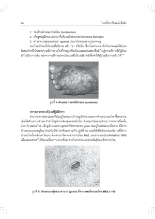 64                                                                   âÃ¤àª×ÍÃÒ·Õ¼ÇË¹Ñ§ªÑ¹ÅÖ¡
                                                                           é    è Ô     é

         1. ÃÍÂâÃ¤ÅÑ¡É³Ðà»š¹¡ŒÍ¹ (tumefaction)
         2. à¡Ô´ÃÙ·ÐÅØÁË¹Í§ÍÍ¡ÁÒ·ÕºÃÔàÇ³¼ÔÇ¢Í§ÃÍÂâÃ¤ (sinus drainage)
                       Õ           è
         3. µÃÇ¨¾º¡ÅØÁ¢Í§ÊÒÂÃÒ (grains) »¹ÁÒ¡ÑºË¹Í§¨Ò¡ÃÙáµ¡·ÐÅØ
                         ‹
         ÃÍÂâÃ¤ÁÑ¡¾ºä´Œº‹ÍÂ·ÕèºÃÔàÇ³ à·ŒÒ, ¢Ò ËÃ×ÍÁ×Í «Öè§à»š¹µíÒáË¹‹§·Õèà¡Ô´ºÒ´á¼Åä´Œº‹ÍÂ
ã¹ÃÍÂâÃ¤·Õà»š¹¹Ò¹æ ¨ÐÁÕ¡ÒÃÅÒÁä»·Õ¡ÃÐ´Ù¡à¡Ô´à»š¹ osteomyelitis «Ö§¹íÒä»ÊÙ¤ÇÒÁ¾Ô¡ÒÃä´Œ ¼Ù»ÇÂ
            è                        è                           è       ‹             Œ †
ÁÑ¡äÁ‹ÁÍÒ¡ÒÃà¨çº ¹Í¡¨Ò¡¨ÐÁÕ¡ÒÃáµ¡à»š¹á¼Å·ÕºÃÔàÇ³¼ÔÇË¹Ñ§«Ö§·íÒãËŒ¼»ÇÂÁÕÍÒ¡ÒÃà¨çºä´Œ
       Õ                                     è               è      ÙŒ †              (1,3)




                        ÃÙ»·Õè 4 ÅÑ¡É³Ð·Ò§¤ÅÔ¹Ô¡¢Í§ mycetoma

       ¡ÒÃµÃÇ¨·Ò§ËŒÍ§»¯Ôºµ¡ÒÃ
                         Ñ Ô
        ÊÒÁÒÃ¶µÃÇ¨¾º grain ·Õ»¹ÍÂÙã¹Ë¹Í§ºÃÔàÇ³ÃÙà»´¢Í§á¼Å¨Ò¡µíÒáË¹‹§ÃÍÂâÃ¤ «Ö§ÊÒÁÒÃ¶
                             è     ‹                                          è
àËç¹ä´Œ´ÇÂµÒà»Å‹ÒáÅÐ¶ŒÒ¹íÒä»´Ù´ÇÂ¡ÅŒÍ§¨ØÅ·ÃÃÈ¹ ¡ç¨ÐàËç¹¡ÅØÁ¡ŒÍ¹¢Í§ÊÒÂÃÒ ¡ÒÃµÃÇ¨ªÔ¹à¹×Í
        Œ                        Œ                         ‹                      é é
¨Ò¡ºÃÔàÇ³ÃÍÂâÃ¤ à¾×Í´ÙÅ¡É³Ð·Ò§¨ØÅ¾ÂÒ¸ÔÇ·ÂÒ¨Ð¾º grain »¹ÍÂÙã¹Ê‹Ç¹¢Í§à¹×ÍµÒÂ ·ÕÁ¡ÒÃ
                    è Ñ                   Ô                       ‹        é       è Õ
ÍÑ¡àÊºáººá¡Ã¹ÙâÅÁÒÃ‹ÇÁ¡ÑºÁÕ¹ÇâµÃ¿ÅÁÒÃÇÁ¡Ñ¹ (ÃÙ»·Õè 5) áÅÐÁÕ¾§¼×´ÅŒÍÁÃÍººÃÔàÇ³·ÕÁ¡ÒÃ
                               Ô                                Ñ                è Õ
ÍÑ¡àÊºã¹ªÑ¹Ë¹Ñ§á·Œ â´Â¨ÐàËç¹ÊÒÂÃÒªÑ´à¨¹¨Ò¡¡ÒÃÂŒÍÁ H&E áÅÐÊÒÁÒÃ¶ÂŒÍÁ¾ÔàÈÉ´ŒÇÂ GMS
          é
à¾×ÍáÊ´§ÊÒÂÃÒä´Œª´à¨¹¢Ö¹ ¡ÒÃà¾ÒÐàª×Í¨Ðª‹ÇÂã¹¡ÒÃ¨íÒá¹¡ÊÒÂ¾Ñ¹¸Ø¢Í§àª×ÍÃÒ¡‹ÍâÃ¤
   è              Ñ     é            é                               é




         ÃÙ»·Õè 5 ÅÑ¡É³Ð¡ÅØ‹Á¢Í§ÊÒÂÃÒ (grain) ·ÕèµÃÇ¨¾ºã¹ÃÍÂâÃ¤;H&E x 100
 