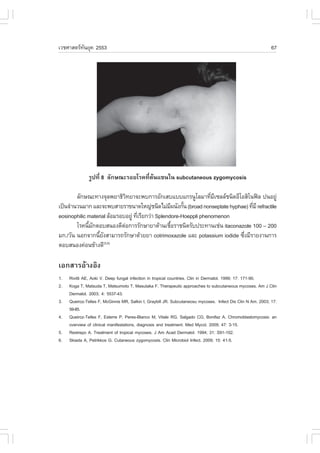 àÇªÈÒÊµÃ·¹ÂØ¤ 2553
          Ñ                                                                                                  67




               ÃÙ»·Õè 8 ÅÑ¡É³ÐÃÍÂâÃ¤·ÕèµŒ¹á¢¹ã¹ subcutaneous zygomycosis

        ÅÑ¡É³Ð·Ò§¨ØÅ¾ÂÒ¸ÔÇ·ÂÒ¨Ð¾º¡ÒÃÍÑ¡àÊºáººá¡Ã¹ÙâÅÁÒ·ÕÁà«ÅÅª¹Ô´ÍÕâÍÊÔâ¹¿Å »¹ÍÂÙ‹
                               Ô                                   è Õ
à»š¹¨íÒ¹Ç¹ÁÒ¡ áÅÐ¨Ð¾ºÊÒÂÃÒ¢¹Ò´ãË­‹ª¹Ô´äÁ‹Á¼¹Ñ§¡Ñ¹ (broad nonseptate hyphae) ·ÕÁÕ refractile
                                                   Õ    é                     è
eosinophilic material ÅŒÍÁÃÍºÍÂÙ‹ ·ÕàÃÕÂ¡Ç‹Ò Splendore-Hoeppli phenomenon
                                    è
        âÃ¤¹ÕÁ¡µÍºÊ¹Í§´ÕµÍ¡ÒÃÃÑ¡ÉÒÂÒµŒÒ¹àª×ÍÃÒª¹Ô´ÃÑº»ÃÐ·Ò¹àª‹¹ itaconazole 100 – 200
             é Ñ             ‹                       é
Á¡./ÇÑ¹ ¹Í¡¨Ò¡¹ÕÂ§ÊÒÁÒÃ¶ÃÑ¡ÉÒ´ŒÇÂÂÒ cotrimoxazole áÅÐ potassium iodide «Ö§ÁÕÃÒÂ§Ò¹¡ÒÃ
                  é Ñ                                                     è
µÍºÊ¹Í§¤‹Í¹¢ŒÒ§´Õ     (5,6)



àÍ¡ÊÒÃÍŒÒ§ÍÔ§
1.   Rivitti AE, Aoki V. Deep fungal infection in tropical countries. Clin in Dermatol. 1999; 17: 171-90.
2.   Koga T, Matsuda T, Matsumoto T, Masutaka .. Therapeutic approaches to subcutaneous mycoses. Am J Clin
     Dermatol. 2003; 4: 5537-43.
3.   Queiroz-Telles ., McGinnis MR, Salkin I, Graybill JR. Subcutaneosu mycoses. Infect Dis Clin N Am. 2003; 17:
     59-85.
4.   Queiroz-Telles ., Esterre P, Peres-Blanco M, Vitale RG, Salgado CG, Bonifaz A. Chromoblastomycosis: an
     overview of clinical manifestations, diagnosis and treatment. Med Mycol. 2009; 47: 3-15.
5.   Restrepo A. Treatment of tropical mycoses. J Am Acad Dermatol. 1994; 31: S91-102.
6.   Skiada A, Petrikkos G. Cutaneous zygomycosis. Clin Microbiol Infect. 2009; 15: 41-5.
 