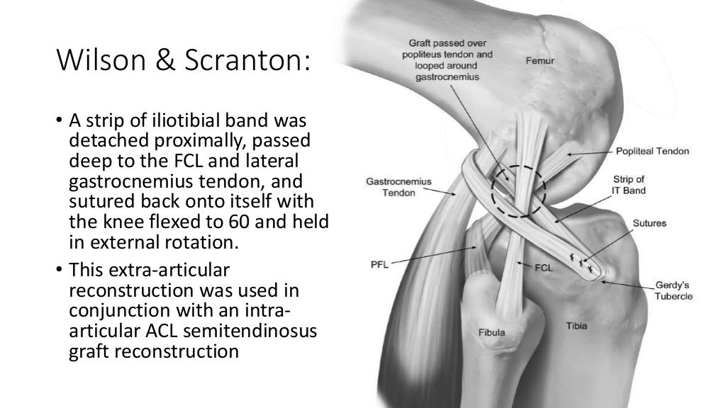 ALL (anterolateral ligament) extra articular ACL reconstruction