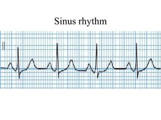 Sinus R1 ECG easy way | PDF