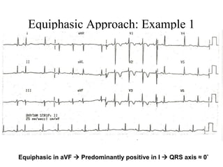 Simple Approach Ecg ECG easy way | PDF