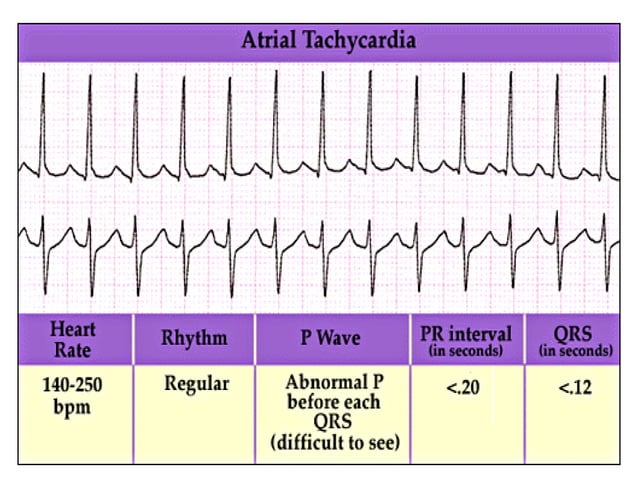 ECG easy way | PPT