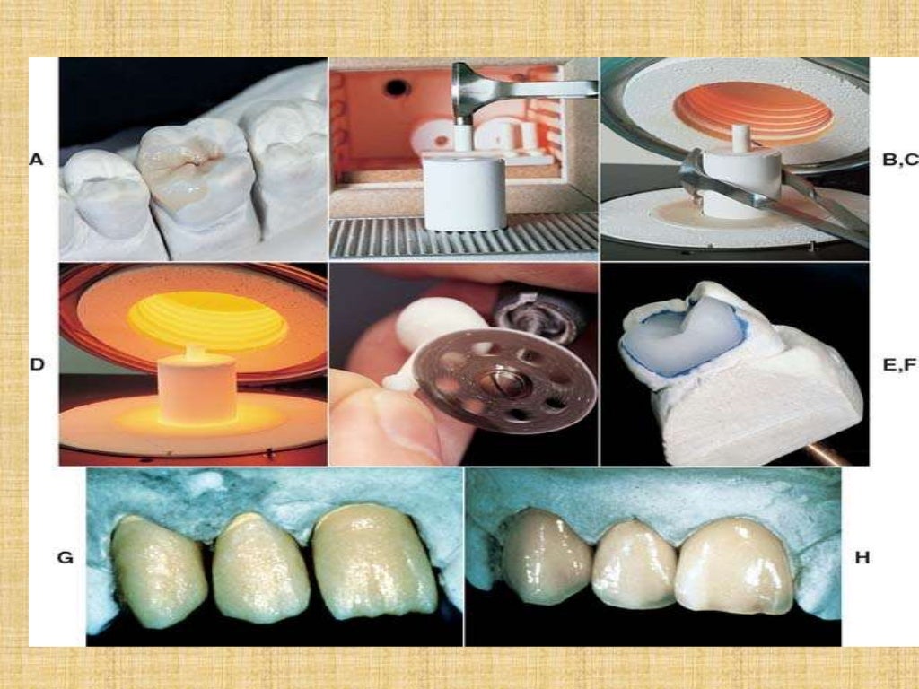 All ceramicrestoration