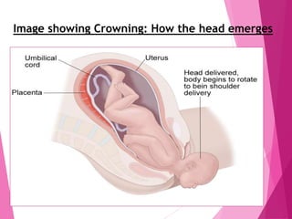 Image showing Crowning: How the head emerges
 