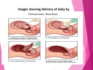 Images showing delivery of baby by
 