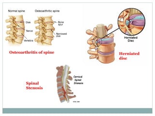 Osteoarthritis of spine Herniated disc Spinal Stenosis 