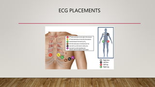 ECG PLACEMENTS
 