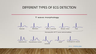 DIFFERENT TYPES OF ECG DETECTION
 