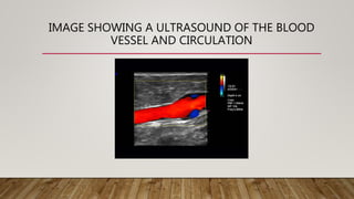 IMAGE SHOWING A ULTRASOUND OF THE BLOOD
VESSEL AND CIRCULATION
 