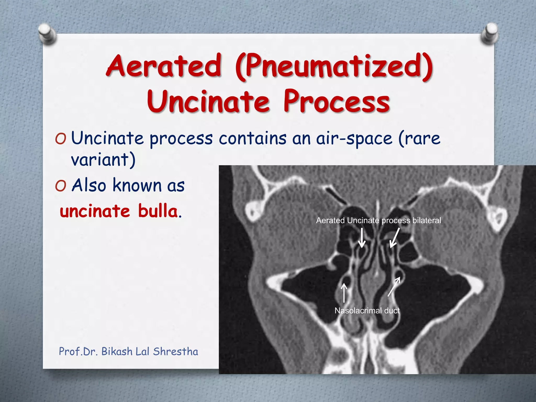 All about uncinate process of nose and paranasal sinuses ppt