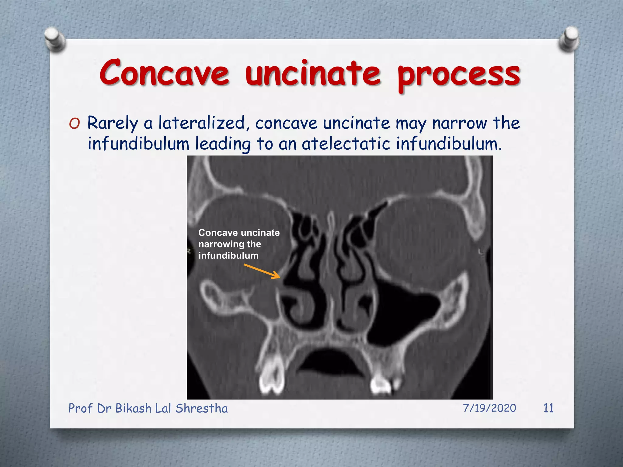 All about uncinate process of nose and paranasal sinuses ppt