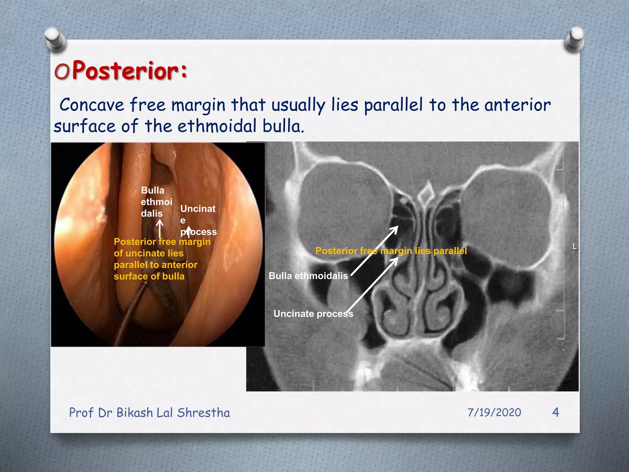 All about uncinate process of nose and paranasal sinuses ppt
