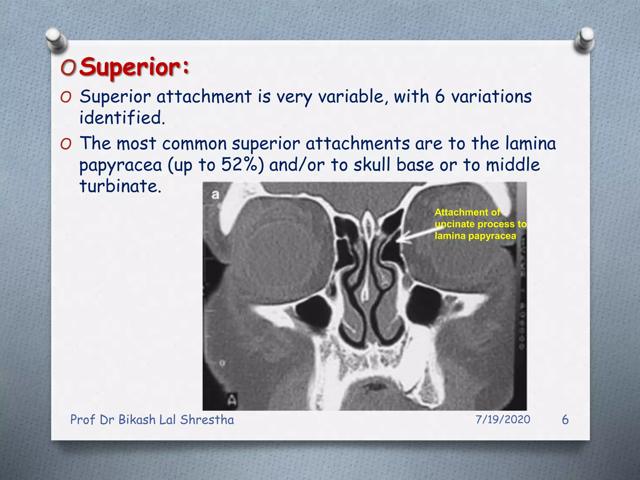 All about uncinate process of nose and paranasal sinuses ppt
