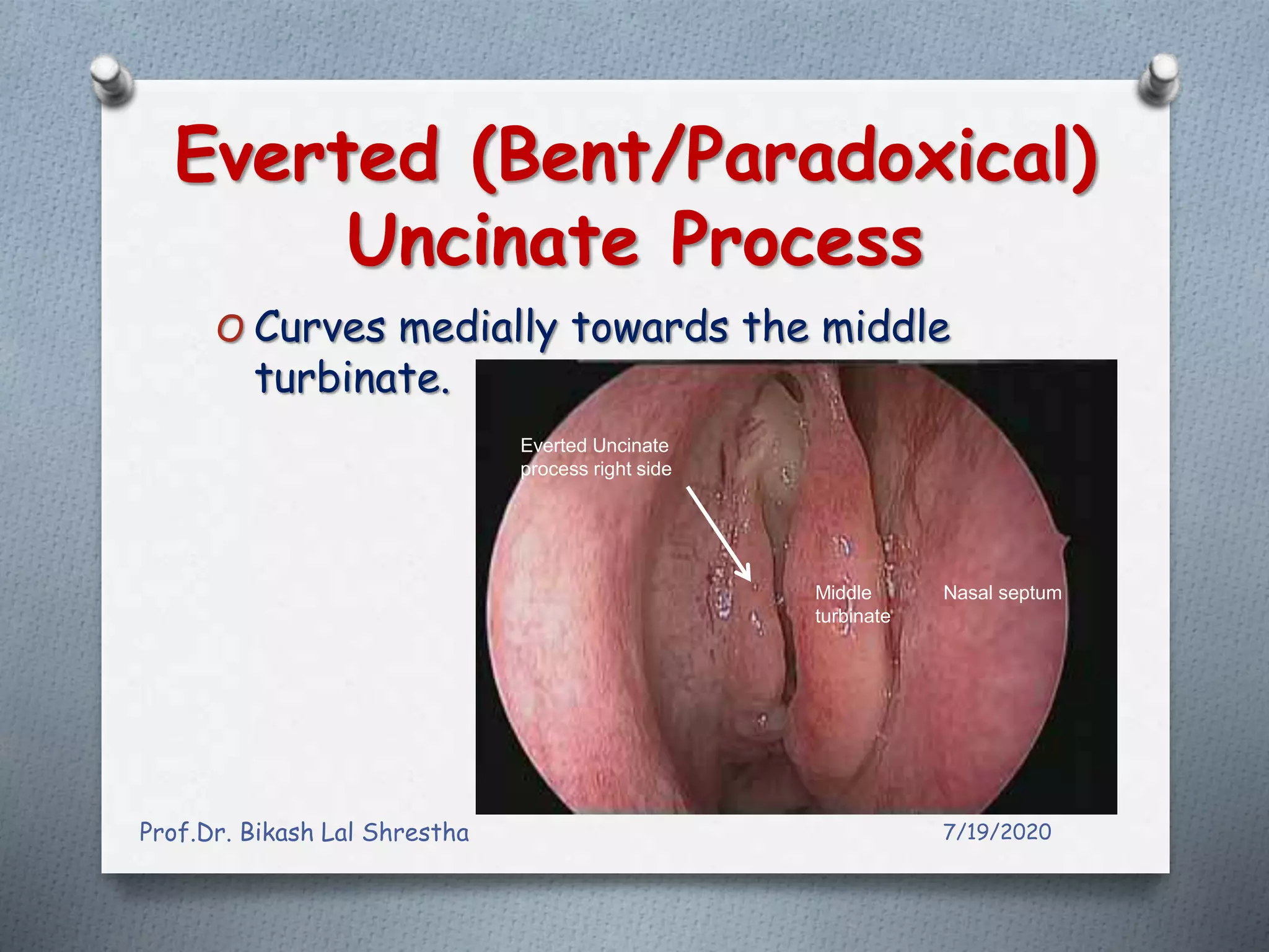 All about uncinate process of nose and paranasal sinuses ppt