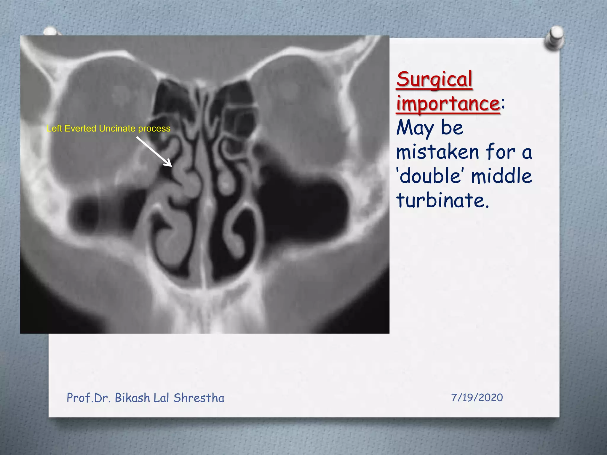 All about uncinate process of nose and paranasal sinuses ppt