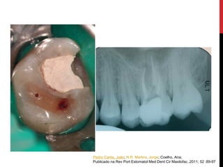 Pedro Canta, João; N.R. Martins, Jorge; Coelho, Ana;
Publicado na Rev Port Estomatol Med Dent Cir Maxilofac..2011; 52 :89-97
 
