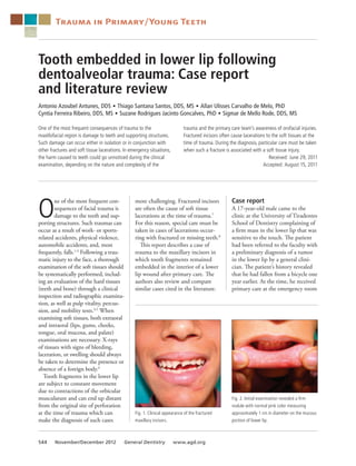Trauma in Primary/Young Teeth

Tooth embedded in lower lip following
dentoalveolar trauma: Case report
and literature review
Antonio Azoubel Antunes, DDS Thiago Santana Santos, DDS, MS Allan Ulisses Carvalho de Melo, PhD
Cyntia Ferreira Ribeiro, DDS, MS Suzane Rodrigues Jacinto Goncalves, PhD Sigmar de Mello Rode, DDS, MS
  n 

  n 

  n 

One of the most frequent consequences of trauma to the
maxillofacial region is damage to teeth and supporting structures.
Such damage can occur either in isolation or in conjunction with
other fractures and soft tissue lacerations. In emergency situations,
the harm caused to teeth could go unnoticed during the clinical
examination, depending on the nature and complexity of the

O

ne of the most frequent consequences of facial trauma is
damage to the teeth and supporting structures. Such traumas can
occur as a result of work- or sportsrelated accidents, physical violence,
automobile accidents, and, most
frequently, falls.1-3 Following a traumatic injury to the face, a thorough
examination of the soft tissues should
be systematically performed, including an evaluation of the hard tissues
(teeth and bone) through a clinical
inspection and radiographic examination, as well as pulp vitality, percussion, and mobility tests.4,5 When
examining soft tissues, both extraoral
and intraoral (lips, gums, cheeks,
tongue, oral mucosa, and palate)
examinations are necessary. X-rays
of tissues with signs of bleeding,
laceration, or swelling should always
be taken to determine the presence or
absence of a foreign body.6
Tooth fragments in the lower lip
are subject to constant movement
due to contractions of the orbicular
musculature and can end up distant
from the original site of perforation
at the time of trauma which can
make the diagnosis of such cases
544

November/December 2012

 

  n 

trauma and the primary care team’s awareness of orofacial injuries.
Fractured incisors often cause lacerations to the soft tissues at the
time of trauma. During the diagnosis, particular care must be taken
when such a fracture is associated with a soft tissue injury.
Received: June 29, 2011
Accepted: August 15, 2011

more challenging. Fractured incisors
are often the cause of soft tissue
lacerations at the time of trauma.7
For this reason, special care must be
taken in cases of lacerations occurring with fractured or missing teeth.8
This report describes a case of
trauma to the maxillary incisors in
which tooth fragments remained
embedded in the interior of a lower
lip wound after primary care. The
authors also review and compare
similar cases cited in the literature.

Fig. 1. Clinical appearance of the fractured
maxillary incisors.

General Dentistry

www.agd.org

Case report
A 17-year-old male came to the
clinic at the University of Tiradentes
School of Dentistry complaining of
a firm mass in the lower lip that was
sensitive to the touch. The patient
had been referred to the faculty with
a preliminary diagnosis of a tumor
in the lower lip by a general clinician. The patient’s history revealed
that he had fallen from a bicycle one
year earlier. At the time, he received
primary care at the emergency room

Fig. 2. Initial examination revealed a firm
nodule with normal pink color measuring
approximately 1 cm in diameter on the mucous
portion of lower lip.

 