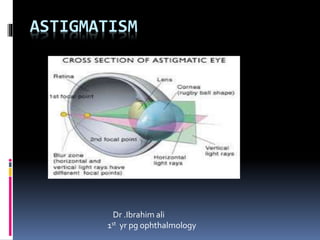 ASTIGMATISM
Dr .Ibrahim ali
1st yr pg ophthalmology
 