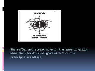 The reflex and streak move in the same direction
when the streak is aligned with 1 of the
principal meridians.
 
