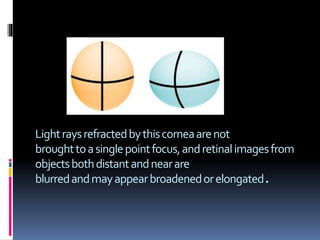 Lightraysrefractedbythiscorneaarenot
broughttoasinglepointfocus,andretinalimagesfrom
objectsbothdistantandnearare
blurredandmayappearbroadenedorelongated.
 