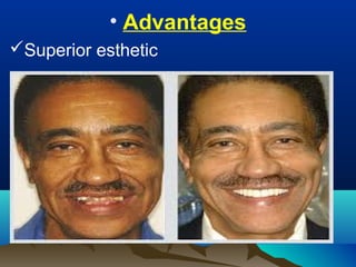 • Advantages
Superior esthetic
 