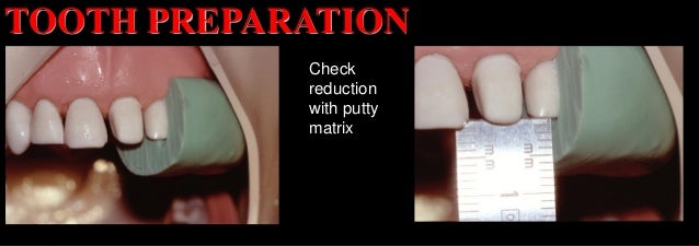 Tooth Preparation All Ceramic Crowns