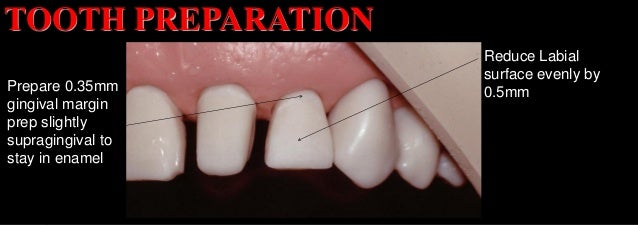 Tooth Preparation All Ceramic Crowns