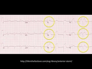 hNp://lifeinthefastlane.com/ecg-­‐library/anterior-­‐stemi/	
  
 