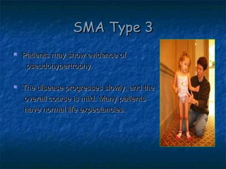 spinal muscular atrophy sma by allelieh Slide 11
