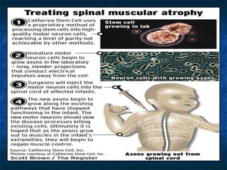 spinal muscular atrophy sma by allelieh Slide 25
