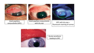 Gpc Condition Allergic conjuctivitis - Etiology to management | PPTX