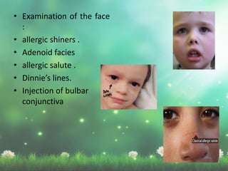 • Examination of the face
:
• allergic shiners .
• Adenoid facies
• allergic salute .
• Dinnie’s lines.
• Injection of bulbar
conjunctiva
 