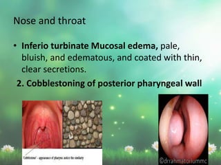 Nose and throat
• Inferio turbinate Mucosal edema, pale,
bluish, and edematous, and coated with thin,
clear secretions.
2. Cobblestoning of posterior pharyngeal wall
 