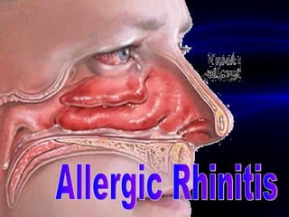 Allergic Rhinitis 