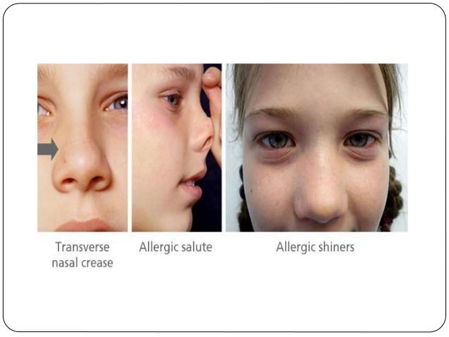 allergic salute
