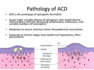 Pathology of ACD
• ACD is the prototype of spongiotic dermatitis
• Acute stage: variable degree of spongiosis with mixed dermal
inflammatory infiltrate containing lymphocytes, histiocytes, and
variable numbers of eosinophils
• Moderate to severe reactions show intraepidermal vesiculation
• Subacute to chronic stages have epidermal hyperplasia, often
psoriasiform

 