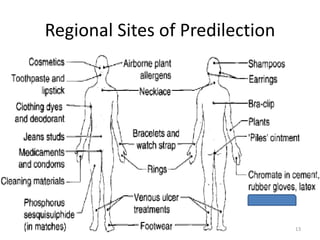 Regional Sites of Predilection

13

 
