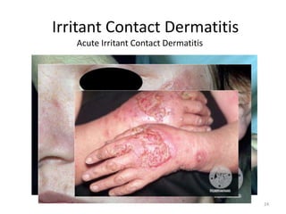 Irritant Contact Dermatitis
Acute Irritant Contact Dermatitis

24

 