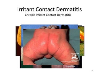 Irritant Contact Dermatitis
Chronic Irritant Contact Dermatitis

26

 