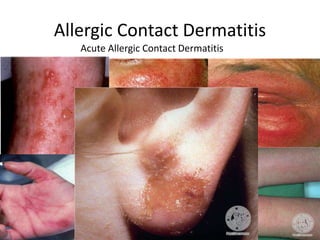 Allergic Contact Dermatitis
Acute Allergic Contact Dermatitis

28

 