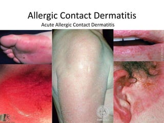 Allergic Contact Dermatitis
Acute Allergic Contact Dermatitis

29

 