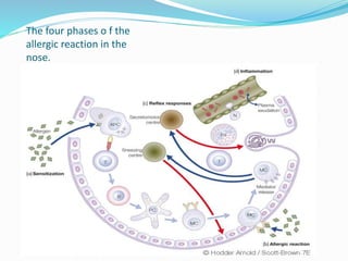 The four phases o f the 
allergic reaction in the 
nose. 
 