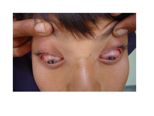ALLERGY AND HYPERSENSITIVITY: PERRENIAL CONJUNCTIVITIS 