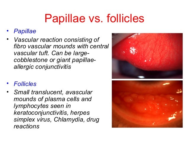 follicular conjunctivitis histology