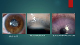 SHILED ULCER PSEUDOGERONTOXON SUPERIOR PUNCTATE EROSIONS
 