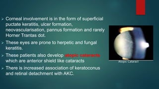  Corneal involvement is in the form of superficial
puctate keratitis, ulcer formation,
neovascularisation, pannus formation and rarely
Horner Trantas dot.
 These eyes are prone to herpetic and fungal
keratitis.
 These patients also develop atopic cataracts
which are anterior shield like cataracts
 There is increased association of keratoconus
and retinal detachment with AKC.
Atopic Cataract
 